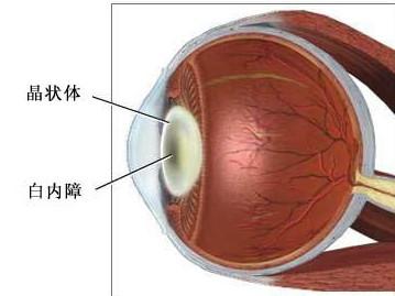 白内障术后注意事项