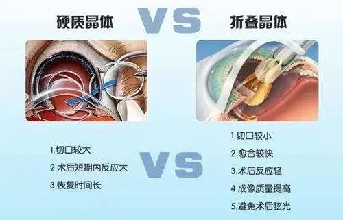 昆明高度近视的白内障患者选择什么人工晶体适合？