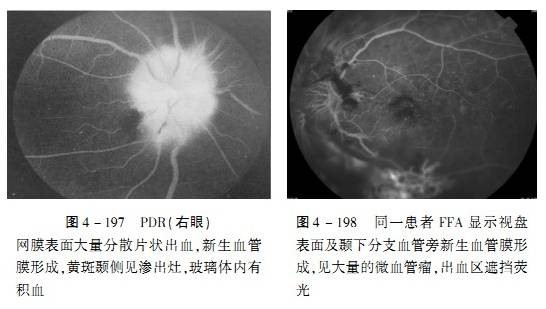 糖尿病性视网膜病变